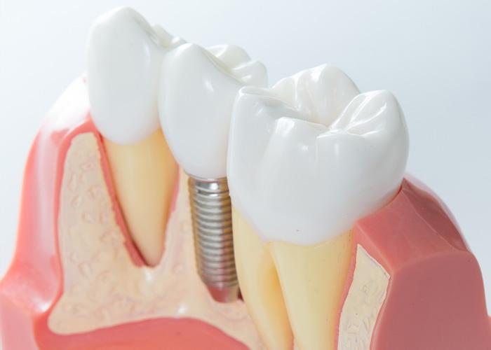 IMPLANTES POSTEXTRACCIÓN Y DE CARGA INMEDIATA